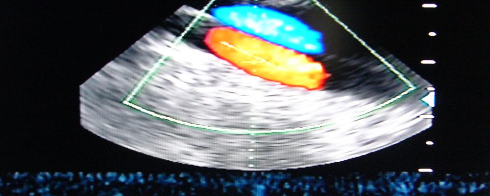 Duplex Ultrasound study of the carotid arteries