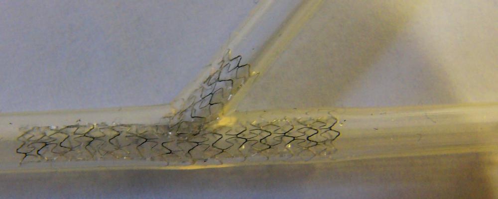 Coronary Angioplasty and Stenting (Balloon dilatation of the coronary arteries along with stent deployment)